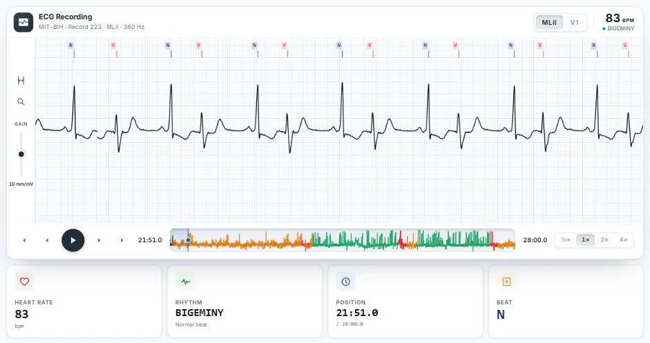 The ECG Player on MIT-BIH record 223, lead MLII: ventricular bigeminy at 83 bpm, with every beat labelled N or V.