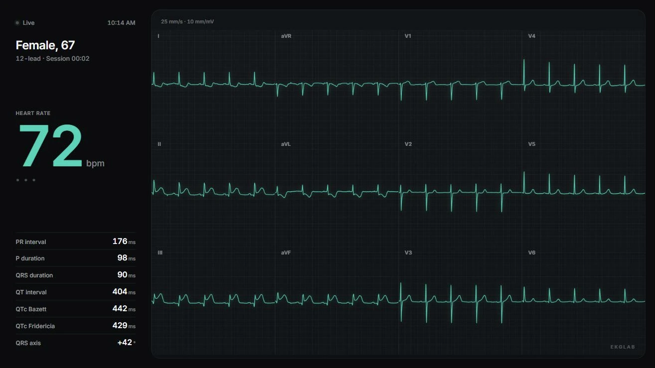The student display showing a full 12-lead broadcast of PTB-XL record 12899, a woman aged 67 with an acute inferior STEMI at 72 bpm: ST elevation in II, III and aVF with reciprocal depression in I and aVL, beside the record's measured intervals.
