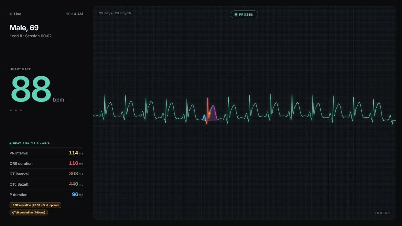The student display showing an ARIA beat analysis broadcast on PTB-XL record 01063, lead II, a man aged 69 with an acute anterior STEMI at 88 bpm: one beat coloured by segment, PR 114 ms, QRS 110 ms, QT 363 ms and QTcB 440 ms, flagged for ST elevation of 0.32 mV at the J point.