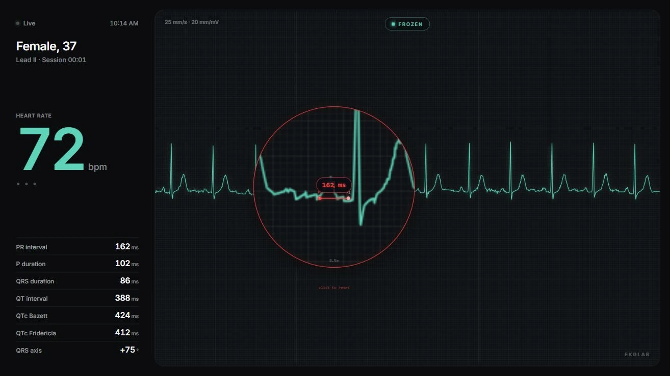 The student display with the magnifier broadcast on PTB-XL record 00174, lead II, a woman aged 37 in normal sinus rhythm at 72 bpm: the lens enlarges one beat 3.5 times, with calipers inside it measuring the PR interval from P-wave onset to QRS onset at 162 ms.