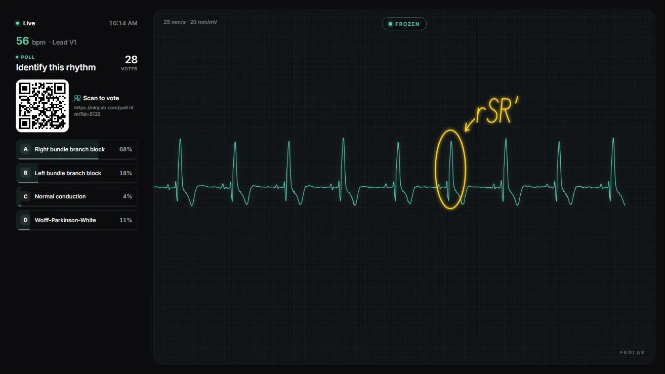 The student display on a classroom TV: PTB-XL record 00788, lead V1, frozen at 56 bpm, showing the rSR' pattern of right bundle branch block: the instructor has circled one complex and handwritten rSR' beside it with an arrow, beside a live poll with a QR code and 28 votes, Right bundle branch block leading at 68 percent.